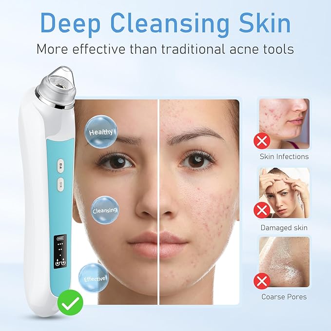 Facial Pore Blackhead Remover Vacuum, 1080P Camera Blackhead Remover, 20x Zoom, 8 LEDs ＆ 3 Suction Modes, 800mAh Battery & USB - 6 Heads Pore Cleaner Kit for Women&Men(Blue)