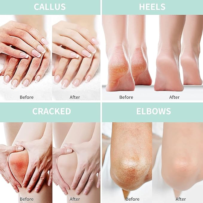Urea Cream 50 Percent for Feet with Coconut 5.29 oz || Foot & Hand Cream Maximum Strength with 2% Salicylic Acid, Tea Tree and Aloe Vera for Deep Moisturizing and Callus Removing