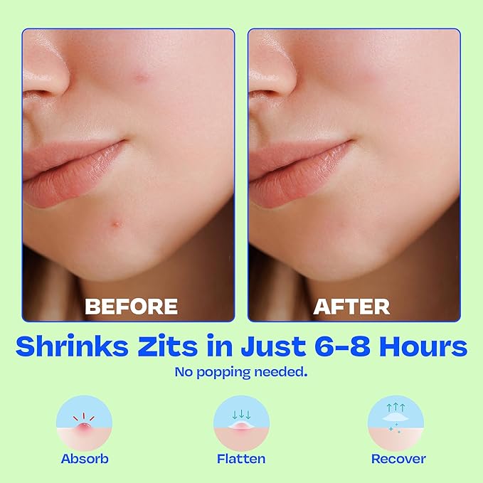The Pimple Patches for Face Acne, Clear Hydrocolloid Patches with Salicylic Acid, Skin Care for Kids & Teens, Korean Skin Care, 3-Pack (25 Small, Medium & Large Spot Treatments per Pack)