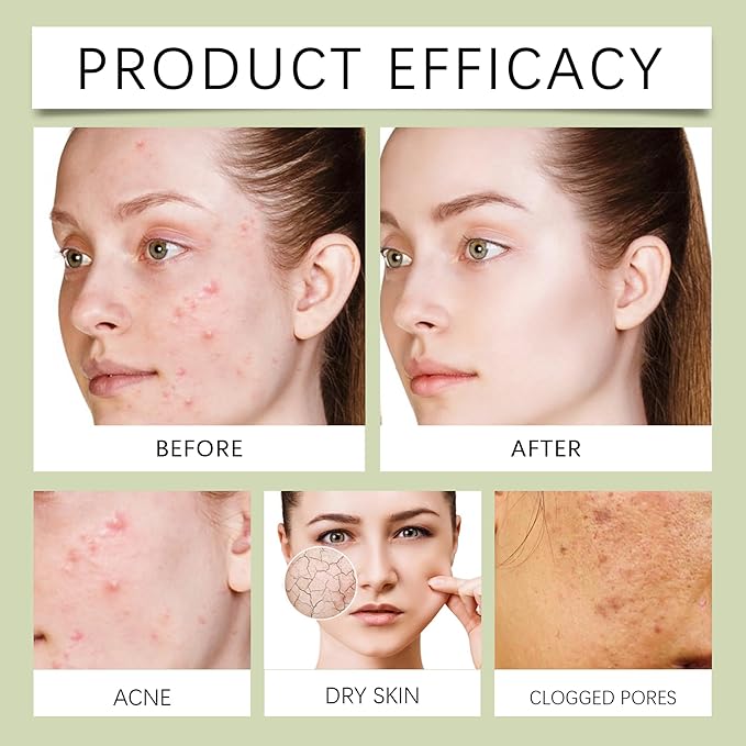 Acne Cream for Face – 15g Oil Balancing Pimple, Helps Reduce Breakouts for Oily & Blemish-Prone Skin, Gentle Daily Moisturizer for Teens & Adults (Unisex, Cruelty-Free)