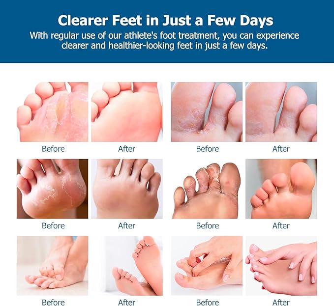 Roycederm Extra Strength Athletes Foot Treatment Cream - Powerful Antifungal Relief for Itching and Burning - Suitable for Men and Women