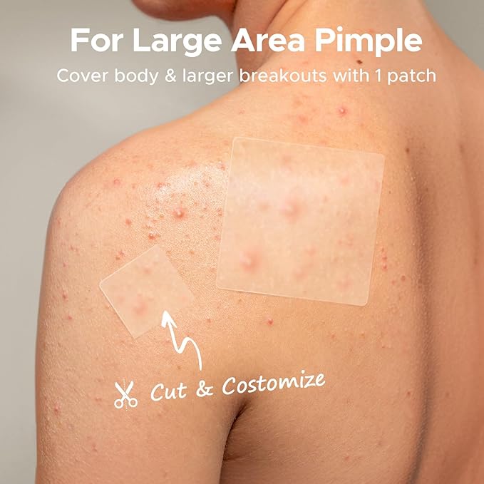 TKTK Large Pimple Patches, 60 mm XL Acne Patches, Big Hydrocolloid Bandages for Body, Face, Forehead, Chin, Neck Zit Breakouts, Hydrocolloid Patch (Square, Strip, Dot 5 Sizes 62 Count)