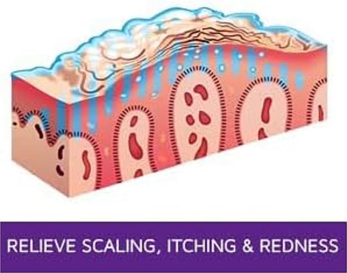 Exfoliating & Moisturizing Ointment – 4oz | Psoriasis Care to Restore Dry, Rough, Cracked or Scaling Skin - Salicylic Acid, Shea Butter, Vitamin E, Steroid-Free | Great for Knees and Elbows