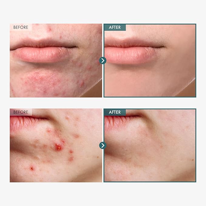 Adenosine Cica Cream, 520,000ppm Centella Asiatica, Redness Reducing for Oily and Dry Skin Moisturizer, Barrier Cream with Niacinamide and Panthenol, Korean Skincare, 100ml, 3.38 fl. oz.