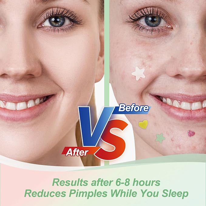 Star Pimple Patches for Face (400 Counts) Festival Beauty Party, Hydrocolloid Cute Acne Patches Cover Zits Blemishes, Zit Patches Spot Stickers Acid Tea Tree Oil,Zit Patches Pads for Skin Care