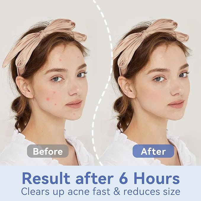 invisible pimple patches for face (72 Count) , 12mm Hydrocolloid acne Patches , Zit Patches, blemish patches for Face,Thin Edge with Fast Absorbing Technology