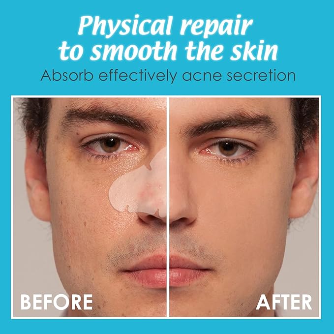 Pimple Patches for Nose 10 CT Acne Patches Nose Pore Strips XL Hydrocolloid Bandages for Face Blemish Pimple Patch Absorbs Oil Overnight