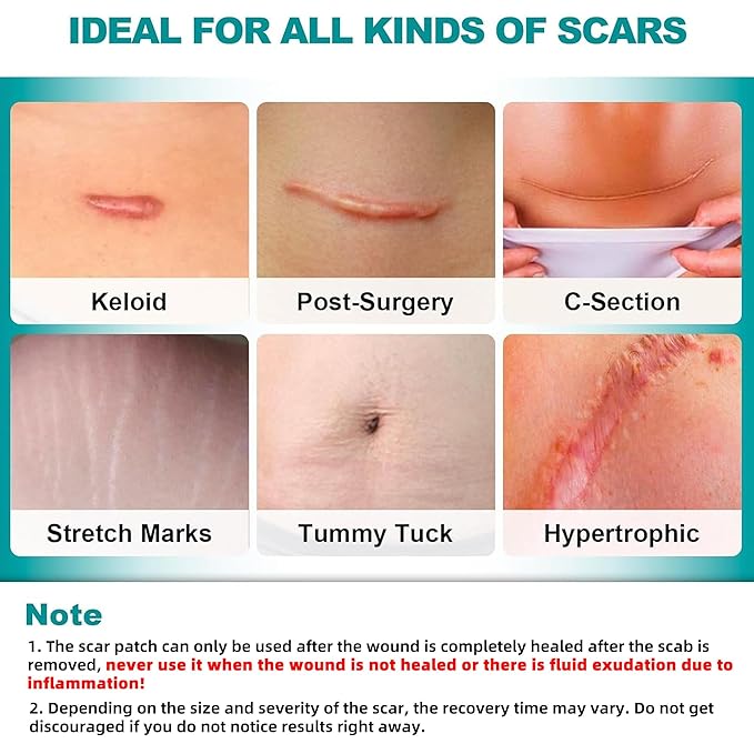 Extra Long Silicone Scar Sheets (1.6”