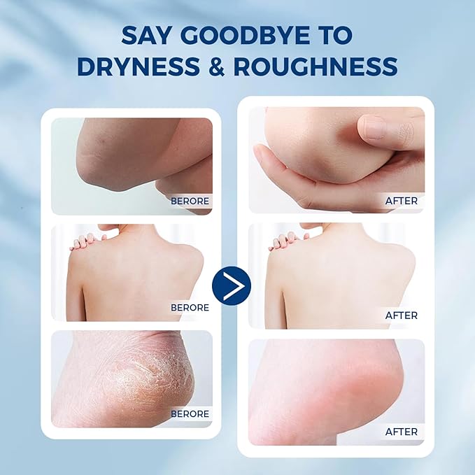 OUKEYA 42% plus Salicylic Acid 2% with 40 percent Urea Cream 40 percent Intensive Repair Treatment for Cracked Skin on Hands, Heels, Elbows, Relief for Dry FeetEnhanced Pump Dispenser Packaging 2 Pack