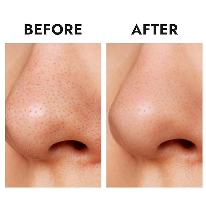 Epielle Over-Zit Nose Patches | Ultimate Hydrocolloid Solution for Clear Skin | 10 Acne Pimple and Blemish Patches for Nose