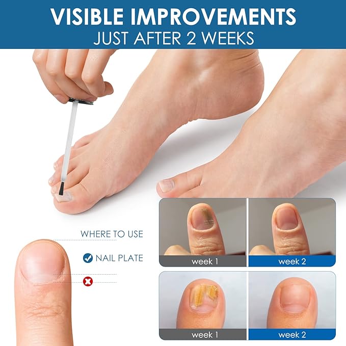 Toenail Repair Treatment, Extra Strength Nail