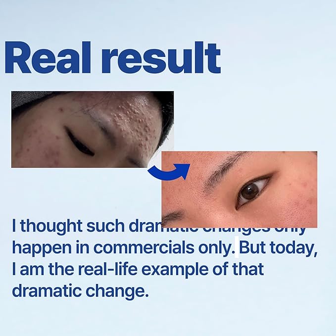 ISOI ACNI Dr. 1st Control Toner, Plant-Based Soothing Formula for Oily & Sensitive Skin, Total Sebum Care & Refreshing Hydration with Cooling Effect, Korean Skin Care (4.39 fl.oz/130ml)