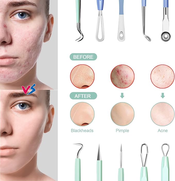 Blackhead Remover Tools MENOLY 10Pcs Pimple Popper Tool Kit, Blackhead Remover Extractor Tools, Acne Kit for Blackhead,Blemish,Zit Whitehead and Comedone Extractor Tool with Leather Bag