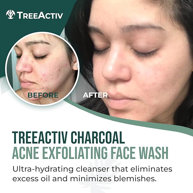 TreeActiv Acne Charcoal Face Wash 3.4 oz, Exfoliating Daily Honey & Sulfur Face Wash - Sulfur Acne Treatment Cleanser Face Soap, Mens Face Wash, Deep Cleansing Moisturizing Face Wash for Women and Men