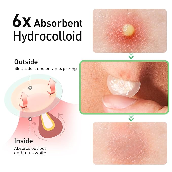 Pimple Patches, 15 mm Invisible Acne Patches for Face with Salicylic Acid, 0.01cm Extra Thin Outer Edge, Hydrocolloid Zit Patch for Pustule, Whitehead, Cystic Acne Spot, 48 Count