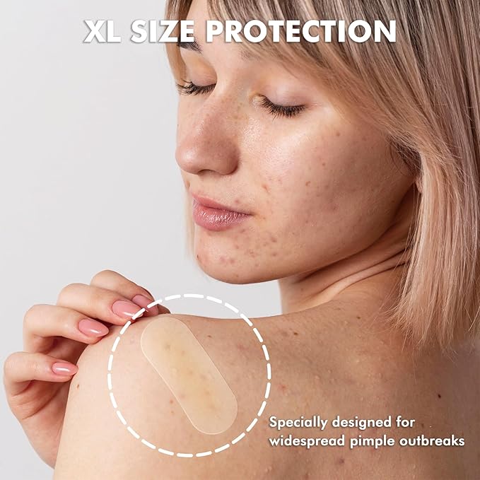 Albatross Health New England Large Acne Pimple Patches for Face (20 Counts), Spot Dots Cover, Hydrocolloid Stickers, Zit Blemish Patch