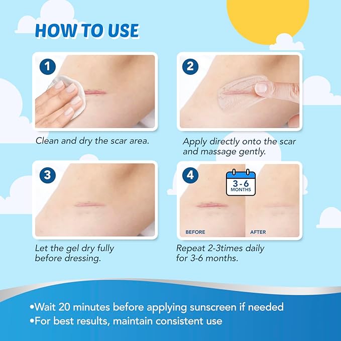 Kids Silicone Scar Gel: Silicone Gel for Scars - Reduces the Appearance of Old and New Scars - Advanced Scar Gel for Face - Body - Scratches - Injuries - Scalds - Burns - Surgery - Kid Friendly - 20g