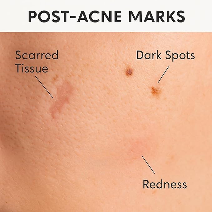 Acne Scar & Dark Spot Patches – Gentle Non-Adhesive Silicone Dots, Safe for Sensitive Skin – Ultra-Thin, Breathable & Nearly Invisible – 72 Pimple Patches, 2 Sizes