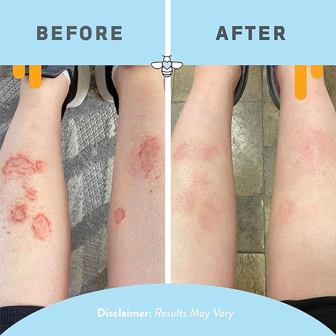 Skin-Renewing Cream - Eczema & Seborrheic Dermatitis Cream - Psoriasis Treatment for Skin, Redness & Itch Relief (4oz)