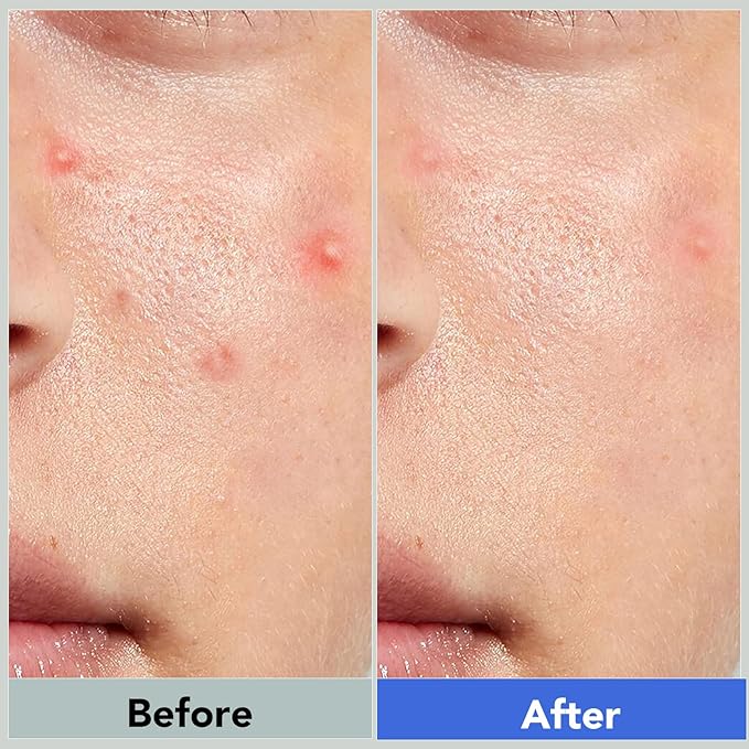 Pimple Patches for Face,Acne Patches for Face,Pimple Patch,Zit Patches,Hydrocolloid Blemish Patches for Covering Zits ,with Salicylic Acid,Tea Tree oil & Calendula oil (108 Counts, Count, 108.0)