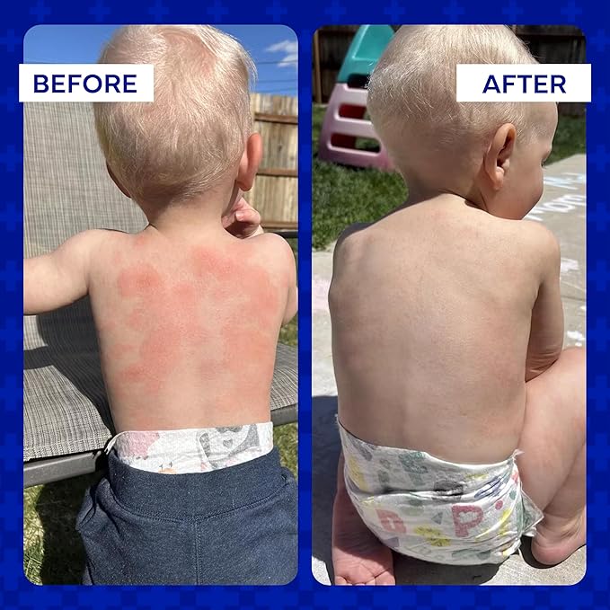 emuaid Ointment for Eczema and Psoriasis Relief, Reduces Itching, Pain, Swelling, Regular Strength Treatment for 100+ Skin Conditions, Steroid and Chemical-Free, Suitable for All Ages, 2oz