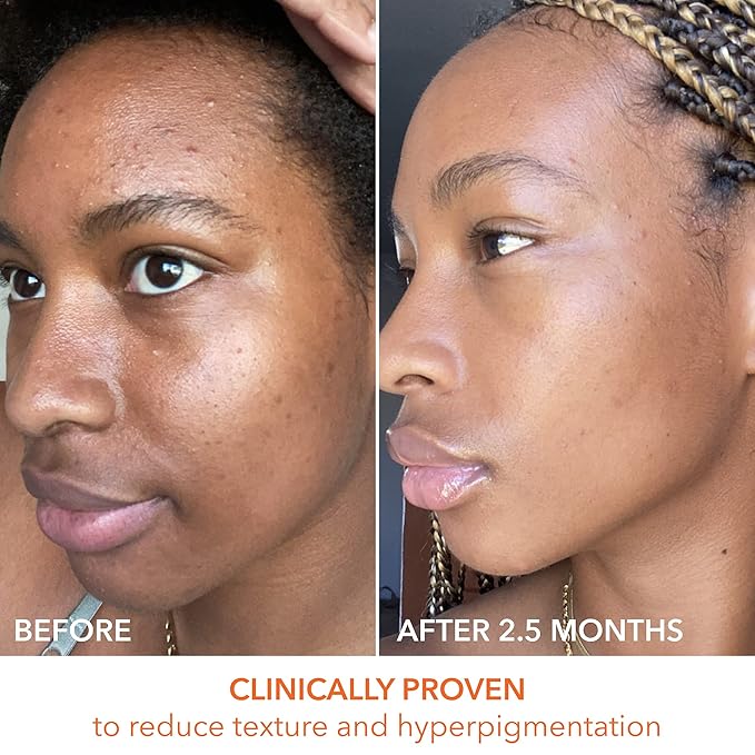 Dr. Dennis Gross Alpha Beta Universal Daily Peel: for Uneven Tone or Texture and Fine Lines or Enlarged Pores, (60 Treatments)