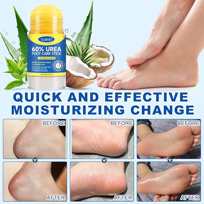 2 PCS Urea Cream 60% Urea Cream 60% Foot Care Stick Deeply Moisturising and Fast Absorbing Gentle Exfoliation For Dry, Cracked Heels & Thickened Skin