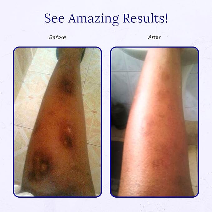 Rejuvaskin Scar Esthetique Scar Cream with Silicone, Reduces the Appearance of Surgical Scars, Burns, Stretch Marks, Keloids & Acne Scars, 30ml