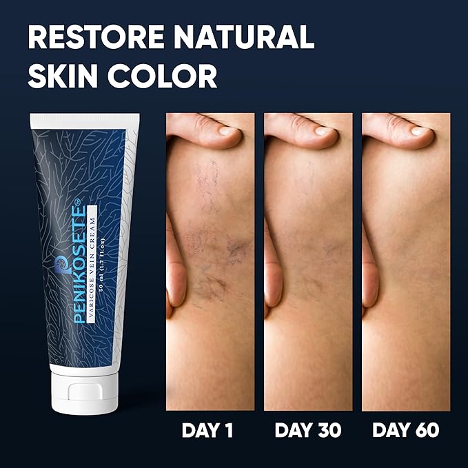 Varicose Veins Treatment | Natural Ayurvedic Cream for Legs with Ashwagandha | Spider Vein Removal Cream for Improved Circulation & Relief From Heavy Fatigued Legs | Non-Sticky