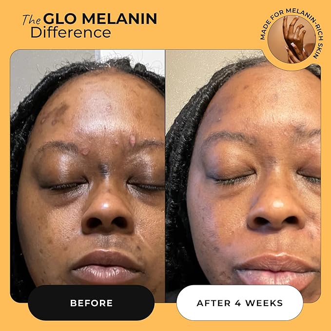 Glo Melanin Dark Spot Remover for Face - Dark Spot Corrector Serum with Vitamin C - Reduces Discoloration and Hyperpigmentation