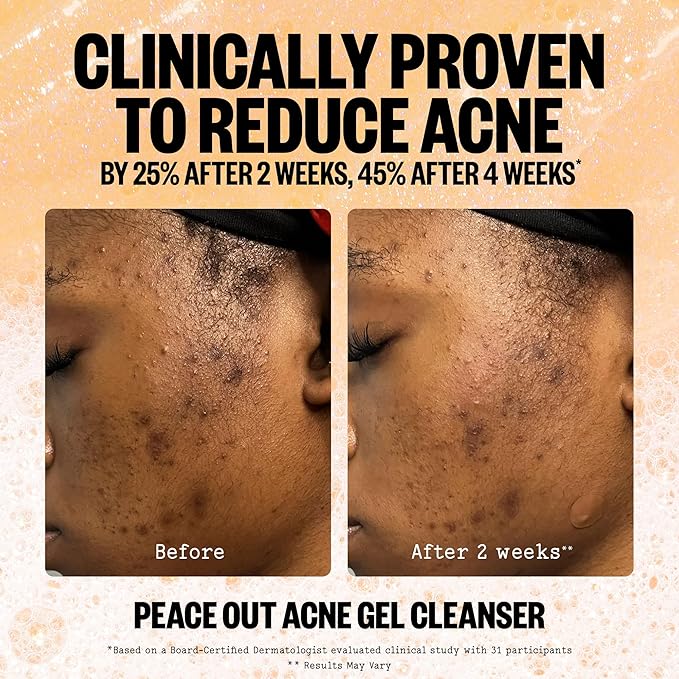 PEACE OUT Skincare Acne Gel Cleanser, Boost Skin Barrier and Help Diminish Blemishes, Daily Acne Face Wash with Salicylic Acid for Men and Women, 4 fl oz