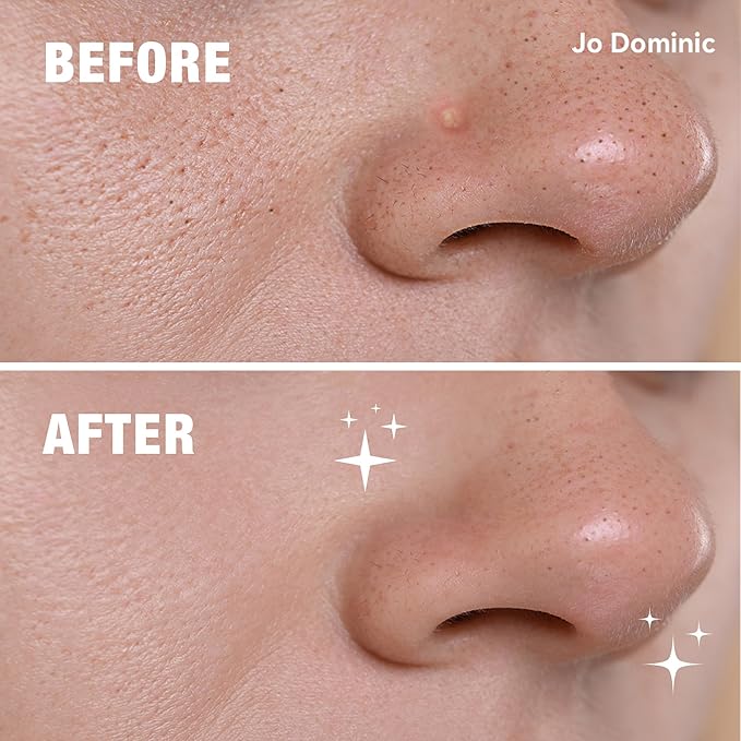 MAGIX PATCH Nose Pimple Patches Hydrocolloid Acne Patches for Nose Pores – Absorbs Oil, Zits & Blemishes Overnight – Vegan, Cruelty-Free Skincare (12 Count)