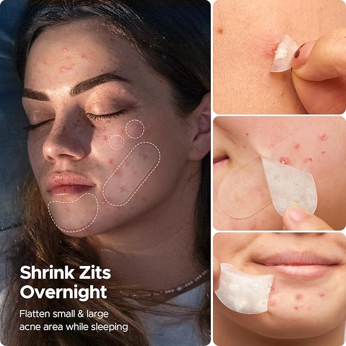 LitBear Pimple Patches for Face, 400 Counts Day and Night Acne Patches, Hydrocolloid Patches for Covering Zit and Blemishes, Large Breakouts, 5 Sizes Thin & Thick Spot Dots Stickers for Chin, Forehead