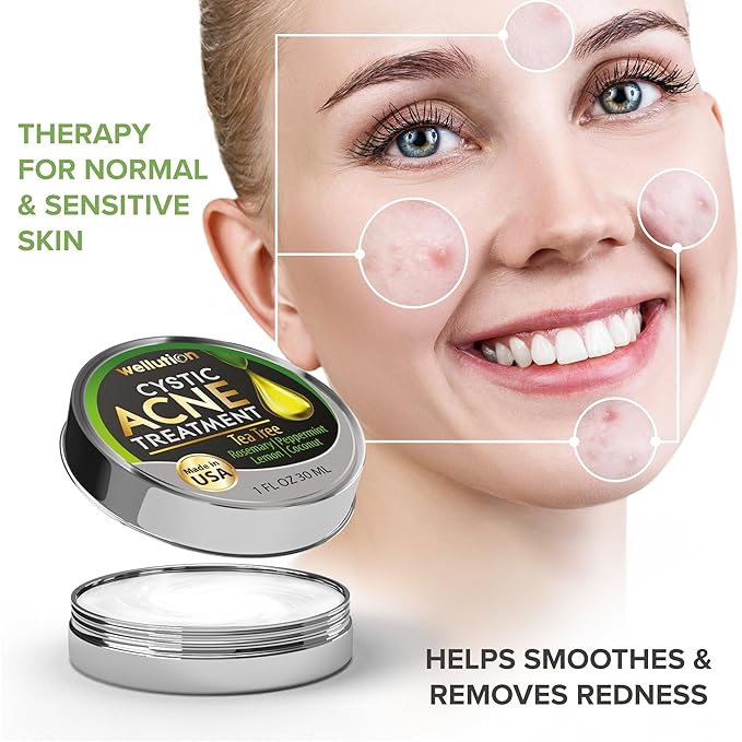 Cystic Acne Spot Treatment – Tea Tree Acne Cream – Fast-Acting Acne Spot Corrector for Face, Pimples & Blemishes – Non-Greasy, Gentle Formula – 1oz – by WELLUTION
