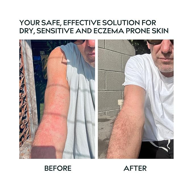 Eczema Relief Balm – Soothing Moisturizer for Face & Body, Dry & Sensitive Skin Barrier Protectant Cream, Flare-Up Treatment for Itchy, Irritated Skin, Steroid & Fragrance-Free
