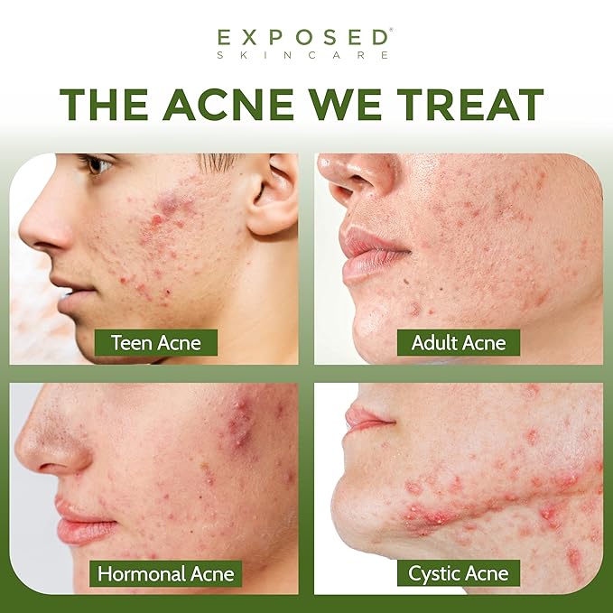 Exposed Skin Care, Acne Treatment Kit with 2.5% Salicylic Acid and 3.5% Benzoyl Peroxide to Clear Up Teen, Adult, Hormonal and Cystic Acne – Natural, Non-toxic and Cruelty Free