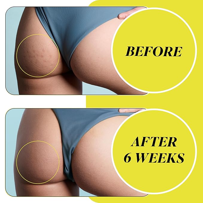 Fur Dark Spot Vanish Patch- Powerful Microdart Patches Designed to Target and Remove Dark Spots and Hyperpigmentation Caused by Body Acne and Ingrown Hairs, While Reducing Ingrown Scars