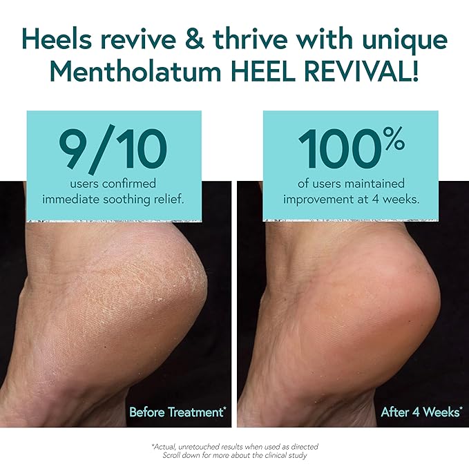 Mentholatum Heel Revival, Persistent Cracked Heel Repair Treatment, 1% Tolnaftate Antifungal Cream, Antifungal Foot Treatment, Eliminates & Prevents Fungus, 1 OZ