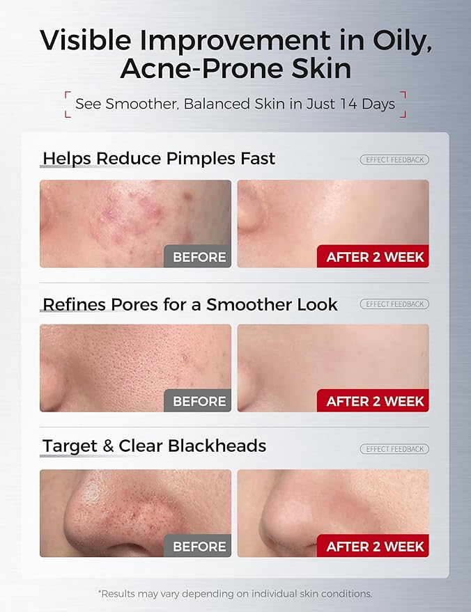 Salicylic Acid Acne Serum – Anti Acne Face Serum with 2% Salicylic Acid, Niacinamide, Centella & PHA – Pore Minimizer, Oil Control, Dark Spot Treatment, Single-Use Vials, 1 Fl.oz