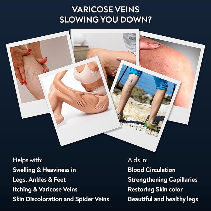 Varicose Veins Treatment | Natural Ayurvedic Cream for Legs with Ashwagandha | Spider Vein Removal Cream for Improved Circulation & Relief From Heavy Fatigued Legs | Non-Sticky