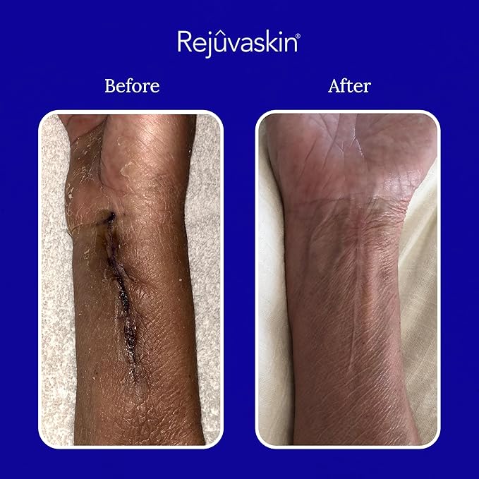 Rejuvaskin Scar Heal Kit for Small to Medium Scars, Soften, Flatten, Reduce and Recover, Silicone Sheeting, RejuvaSil Gel & Medical Tape, 1.5" x 5"