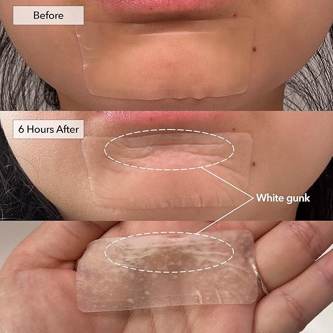 FreeGo Hydrocolloid Acne Patches for Face, Large Pimple Patches for Breakouts, Zit, Blemish Spot, Facial Stickers, Korean Pimple Patches