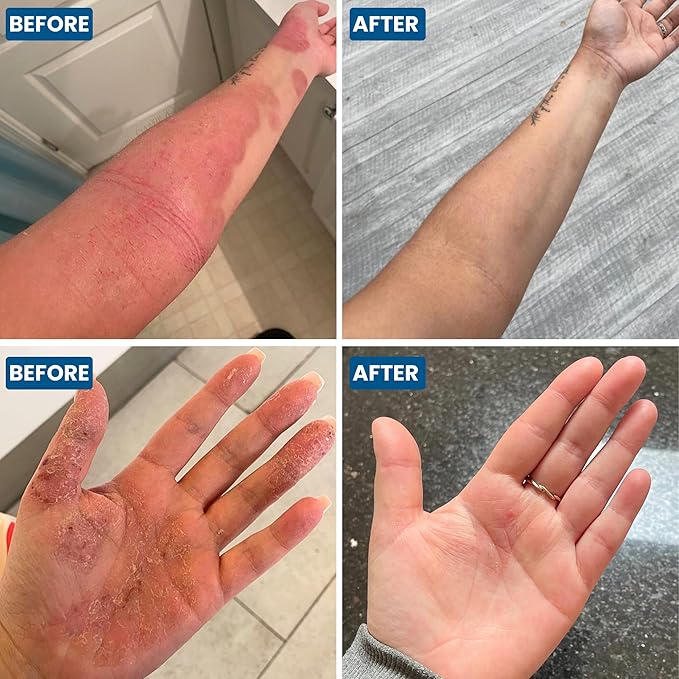 C+ Eczema Relief Cream - Steroid-Free Moisturizer Soothes Dermatitis, Inflammation, Redness Treatment for Irritated, Dry Skin - All Natural Ingredients with Manuka Honey, (4.23oz)