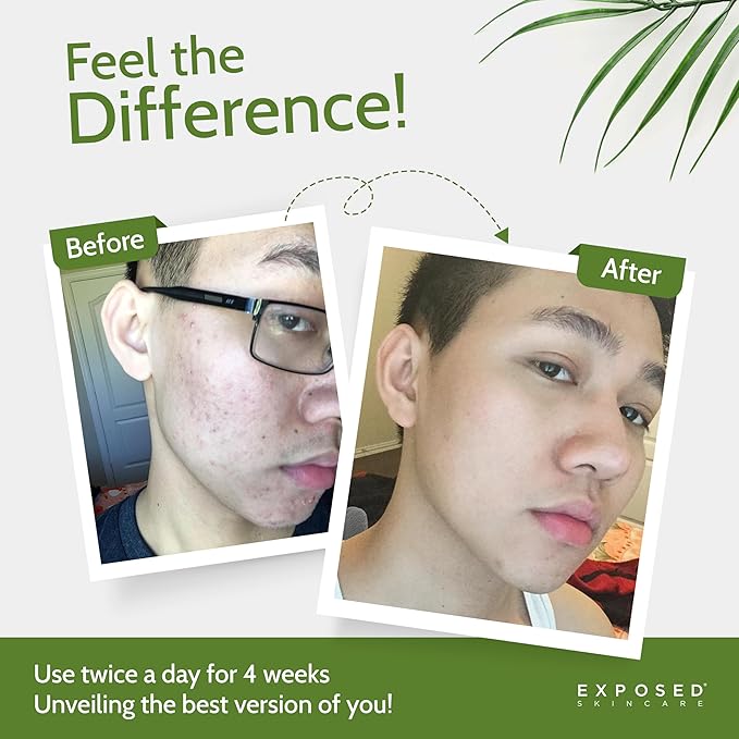 Exposed Skin Care Acne Treatment Serum – Lightweight Acne Spot Treatment with Micro Benzoyl Peroxide, Green Tea & Tea Tree Oil, Quickly Clears Pimples and Breakouts, 2.7 Fl Oz