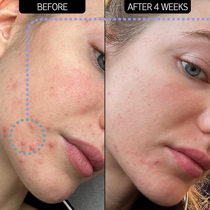 The INKEY List SuperSolutions Novoretin 2% Moisturizer, Skin Clearing Moisturizer to Reduce Blemishes and Breakouts While You Sleep, Non-Comedogenic 1.69 fl oz