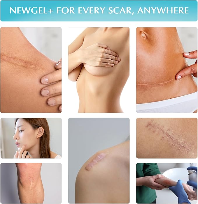 Advanced High-Potency Silicone Scar Gel with Vitamin E for Old, New Scars, Surgery, Keloids, Burns, and Facial Blemish Scars, NewGel Plus by MyNewGel (15 Grams) - 0.50 oz