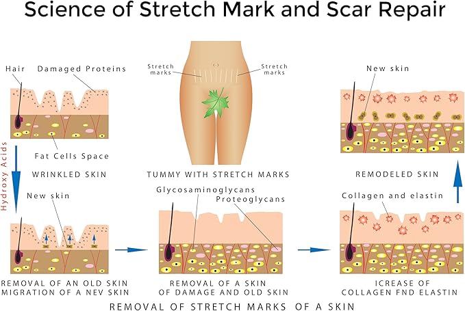 Best Stretch Marks Cream Prevent & Reducing