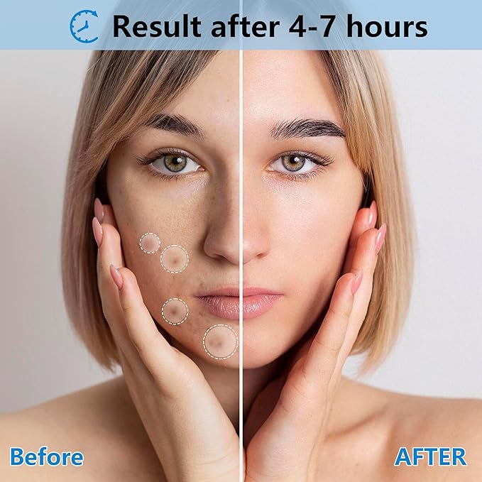 Invisible Pimple Patches for Face,Day and Night 4 Sizes 360 Counts Thin & Thick Hydrocolloid Acne Patches for Face and Skin, Zits Absorbing Patch, Covering Zits and Blemishes, Spot Stickers