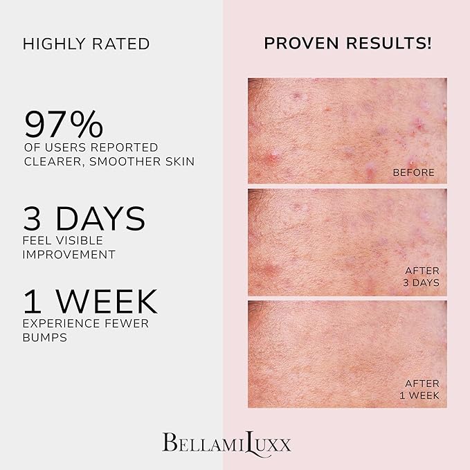 Butt Acne Clearing Treatment Cream: Body Acne Treatment for Folliculitis and Pimples on Buttocks, Thighs With 2% Salicylic Acid & Tea Tree Oil - Butt Cream for Smooth Skin