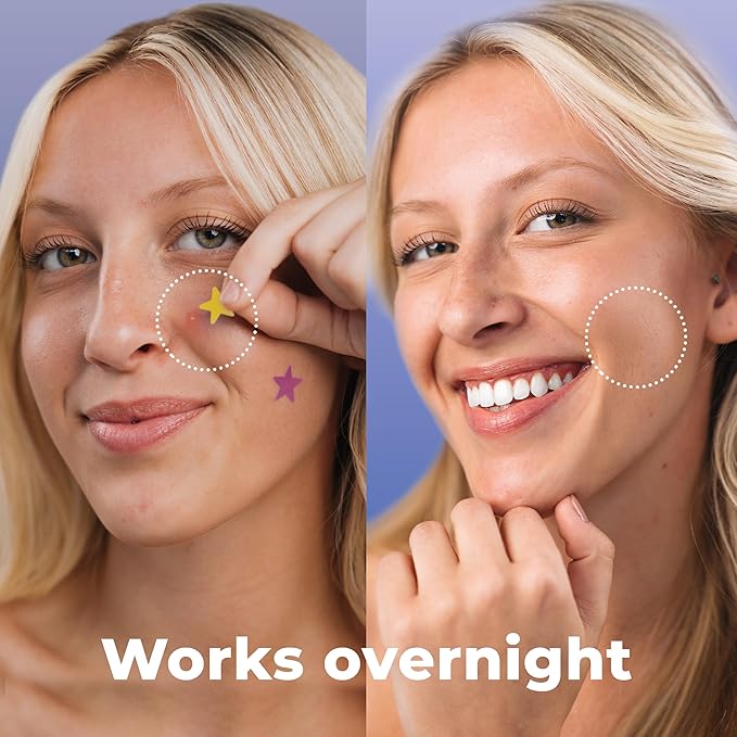 Star Pimple Patches for Face (240 Patches) with Hydrocolloid Only, Cute Acne Patches, Star Patches for Teens and Adults Zit Patches Stickers for Face, Fun Blemish Patches